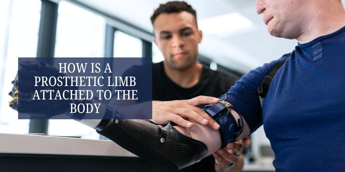 How Is a Prosthetic Limb Attached to the Body