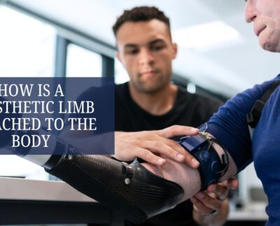 How Is a Prosthetic Limb Attached to the Body