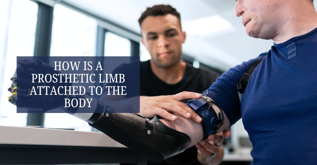 How Is a Prosthetic Limb Attached to the Body