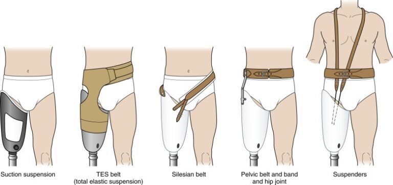 Understanding Prosthetics Socket Design: Types, Purpose & Importance