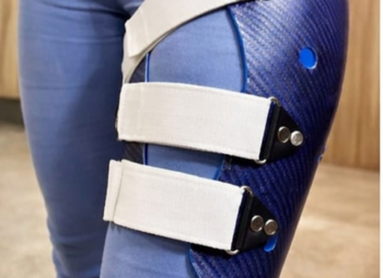 Midshaft Femur Non-Union in a 21-Year-Old Female: Advanced Orthotic Management with Femoral Functional Fracture Brace