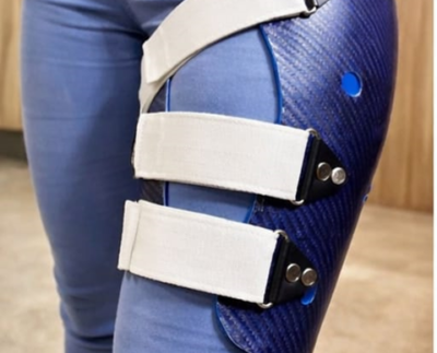 Midshaft Femur Non-Union in a 21-Year-Old Female: Advanced Orthotic Management with Femoral Functional Fracture Brace