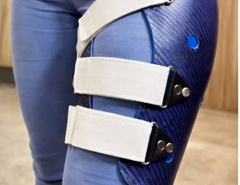 Midshaft Femur Non-Union in a 21-Year-Old Female: Advanced Orthotic Management with Femoral Functional Fracture Brace