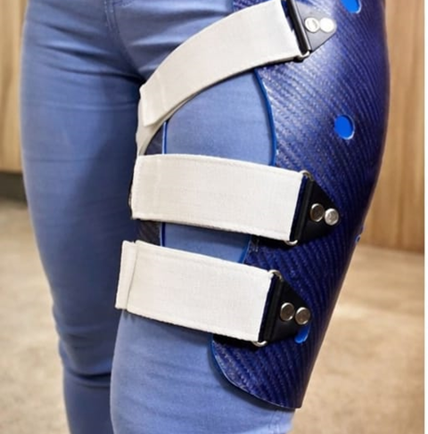 Midshaft Femur Non-Union in a 21-Year-Old Female: Advanced Orthotic Management with Femoral Functional Fracture Brace