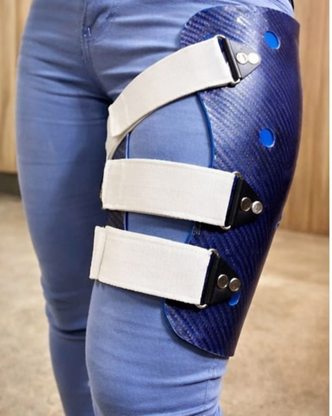 Midshaft Femur Non-Union in a 21-Year-Old Female: Advanced Orthotic Management with Femoral Functional Fracture Brace