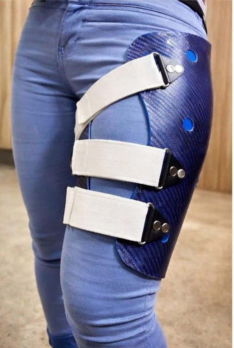 Midshaft Femur Non-Union in a 21-Year-Old Female: Advanced Orthotic Management with Femoral Functional Fracture Brace