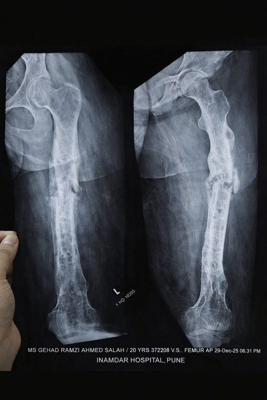 Hypertrophic femoral non-union X-ray