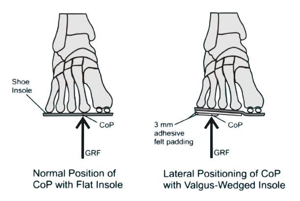 Diagram showing the effect of valgus-wedged insoles on foot biomechanics and Ground Reaction Force