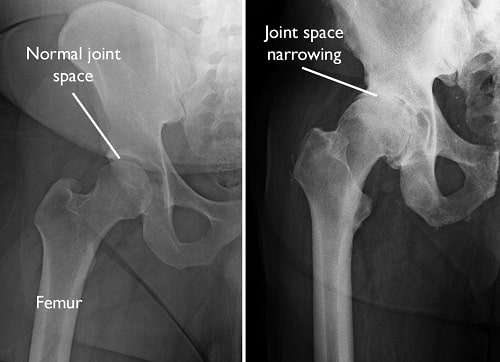 Hip osteoarthritis X-ray showing joint space narrowing compared to normal hip joint.