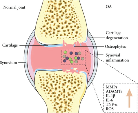 Diagram comparing a normal joint with an osteoarthritis (OA) joint, highlighting cartilage degeneration, osteophytes, and synovial inflammation