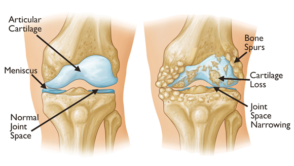 Illustration comparing a healthy knee joint to a knee with osteoarthritis
