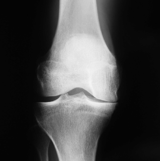 Osteoarthritis