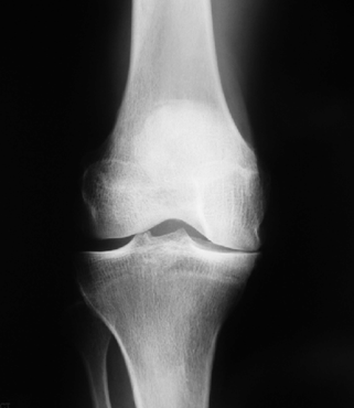 Osteoarthritis