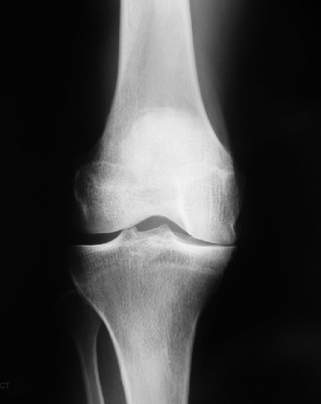 Osteoarthritis