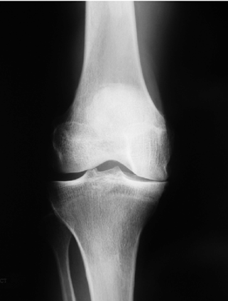 What Is an Osteoarthritis? Role of a Certified Orthotist in Advanced Orthotic Management