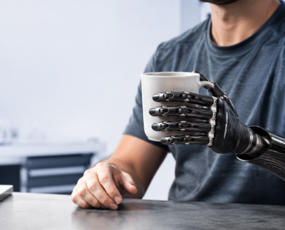Finger and Hand Prosthetics When and Why to Invest