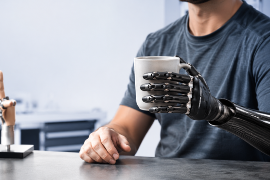 Finger and Hand Prosthetics When and Why to Invest
