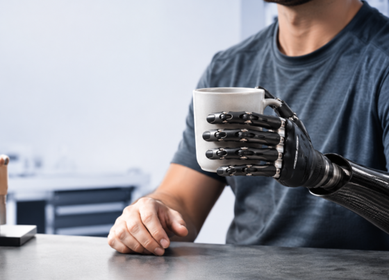 Finger and Hand Prosthetics When and Why to Invest