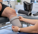 Understanding Prosthetic Liners, Sockets, and Suspension Systems